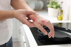 Врач предостерегла от частых ошибок при оказании первой помощи при ожогах